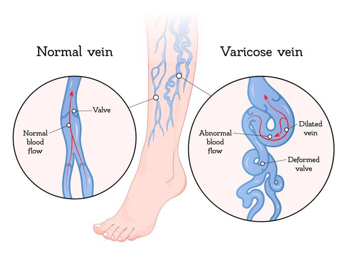 Varicose Veins: Understanding the Problem and Ayurvedic Solutions - VINAMRIT